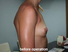 plastic-surgery-breast-augmentation 